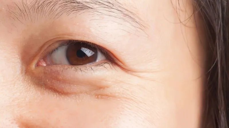 Bọng mắt có liên quan đến quá trình lão hóa
