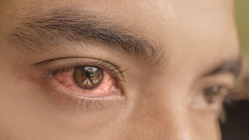 Đau mắt đỏ là bệnh lý phổ biến và ai cũng có thể mắc bệnh này