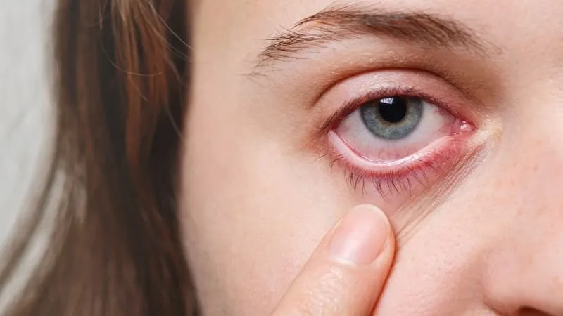 Dị ứng mắt (eye allergy) xảy ra khi mắt tiếp xúc với các chất gây kích ứng