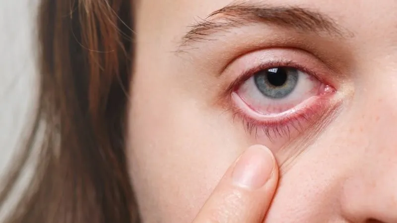 Mắt không sản xuất đủ nước mắt là nguyên nhân dẫn đến khô mắt