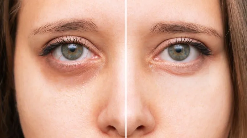 Quầng thâm dưới mắt làm ảnh hưởng đến vẻ ngoài